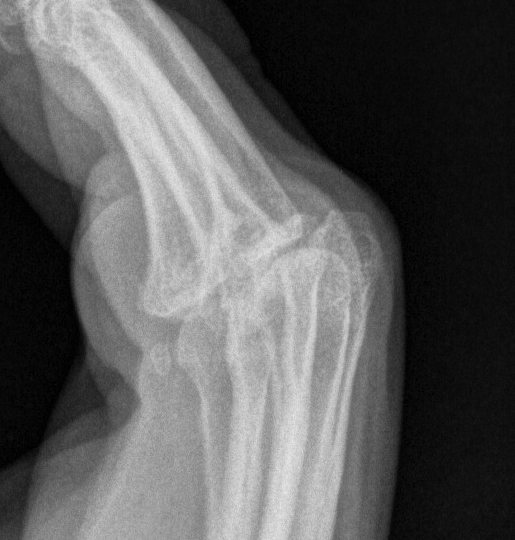 Rheumatoid Dislocated MCPJ